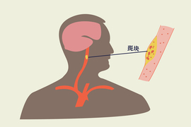 中药力量再现！5个月，颈动脉斑块“缩小”超56%！